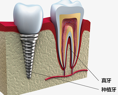 种植牙 种植牙