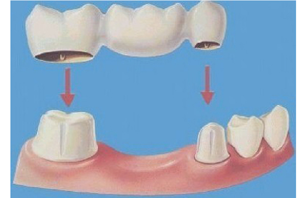 固定假牙 固定假牙
