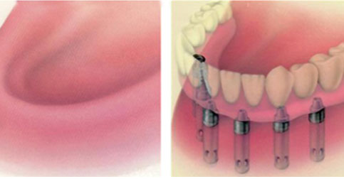 全口种植牙示意图 全口种植牙示意图