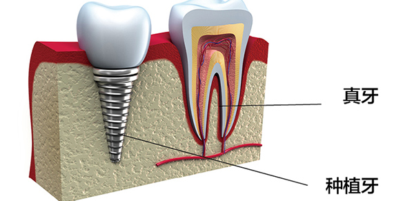 真牙与种植牙对比图 真牙与种植牙对比图