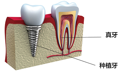 种植牙剖面图-苏州美奥口腔 种植牙剖面图-苏州美奥口腔