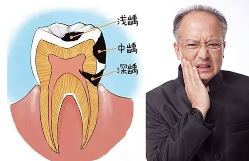 老年人龋齿缺牙-苏州美奥口腔 老年人龋齿缺牙-苏州美奥口腔