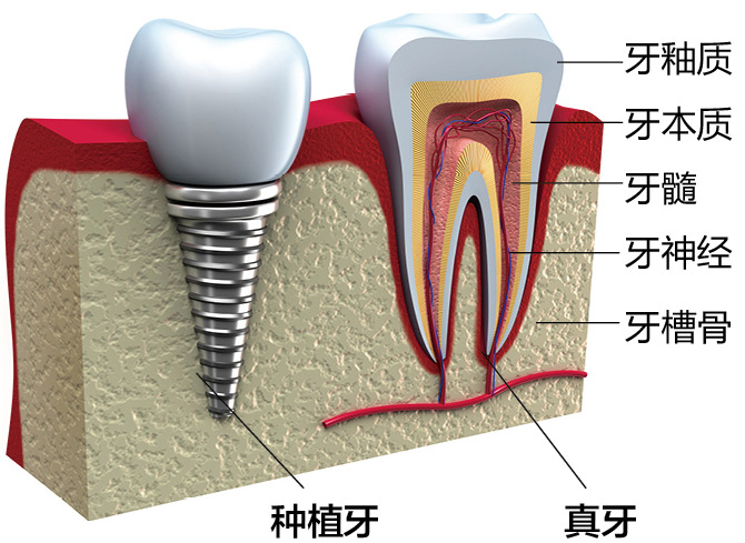 种植牙与真牙对比图 种植牙与真牙对比图